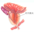 前列腺囊腫
