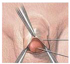 包皮過(guò)長(zhǎng)